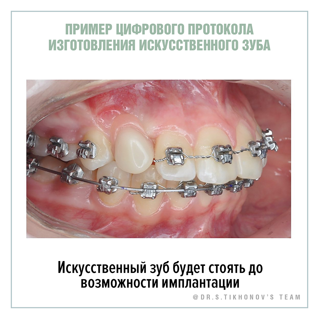 Временное протезирование клыка: от сканирования до установки. - интересно  об ортодонтии, имплантации и протезировании зубов